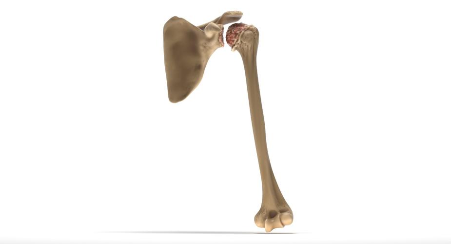 arthritis model cro,Understanding the Arthritis Model Cro: A Comprehensive Overview