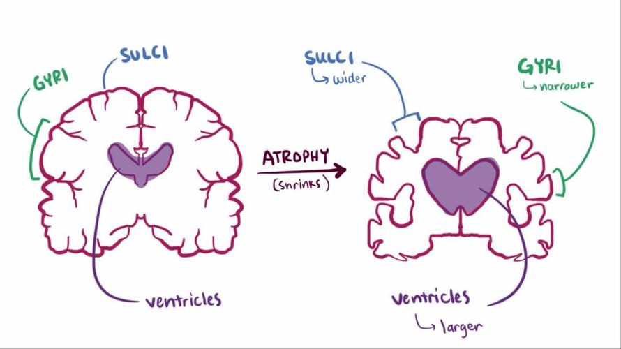 alzheimer’s disease cro,Understanding Alzheimer’s Disease: A Comprehensive Overview for You